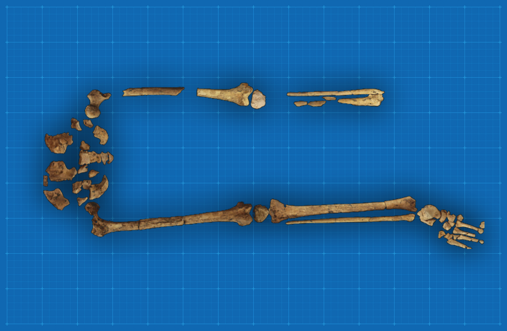 Une découverte repousse la première amputation médicale connue il y a