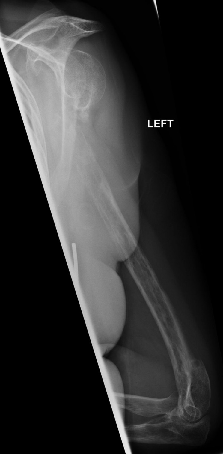 Rare Disease Causes Woman's Bones to Literally Disappear