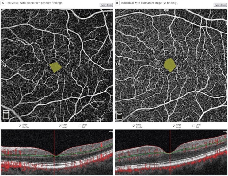 Alzheimer's Disease May Be Predicted with a Simple Eye Exam Alzheimer's Disease May Be Predicted with a Simple Eye Exam