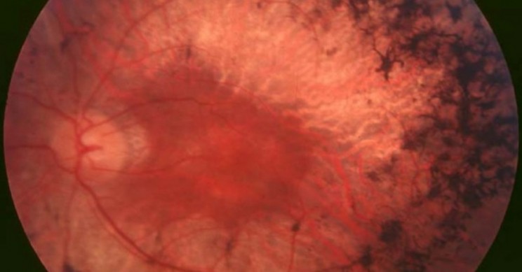 Radical Gene Therapy Treatment Tackles Eye Disease