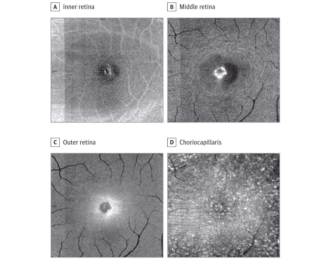 The Solar Eclipse Burnt Its Imprint on This Woman's Retina The Solar Eclipse Burnt Its Imprint on This Woman's Retina