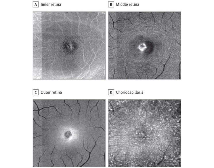 The Solar Eclipse Burnt Its Imprint on This Woman's Retina The Solar Eclipse Burnt Its Imprint on This Woman's Retina