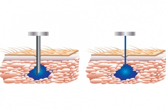 This Needle-Free Injector is About to Replace Traditional Shots This Needle-Free Injector is About to Replace Traditional Shots