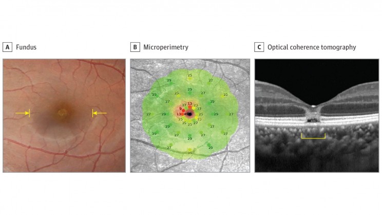 The Solar Eclipse Burnt Its Imprint on This Woman's Retina The Solar Eclipse Burnt Its Imprint on This Woman's Retina