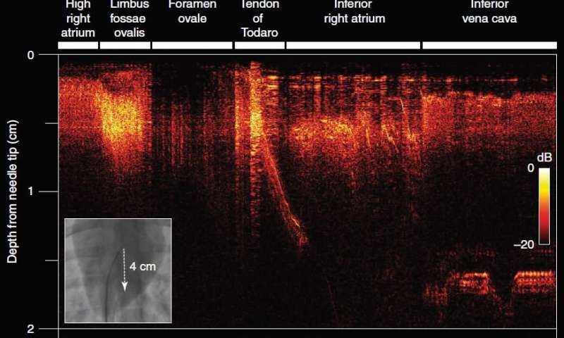 New Surgical Needle Can Send Real-Time Ultrasound Images to Surgeons New Surgical Needle Can Send Real-Time Ultrasound Images to Surgeons