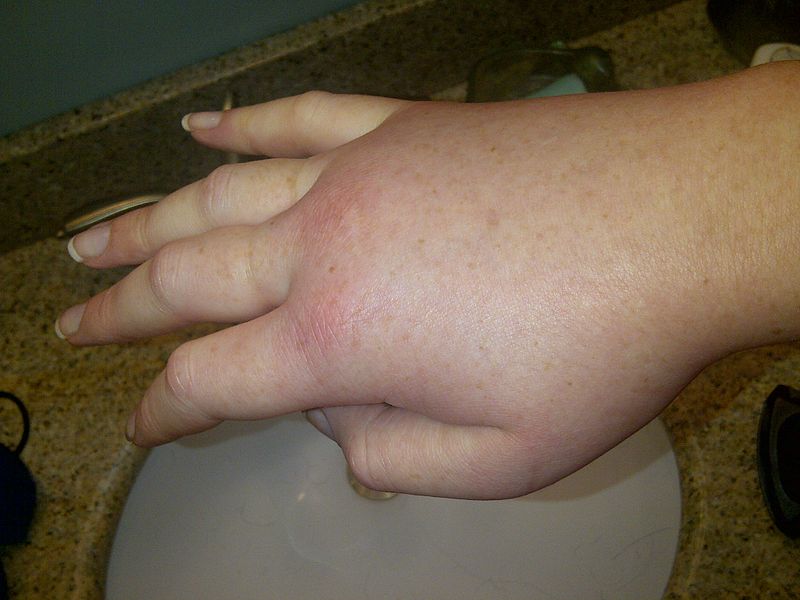 Rare diseases HAE