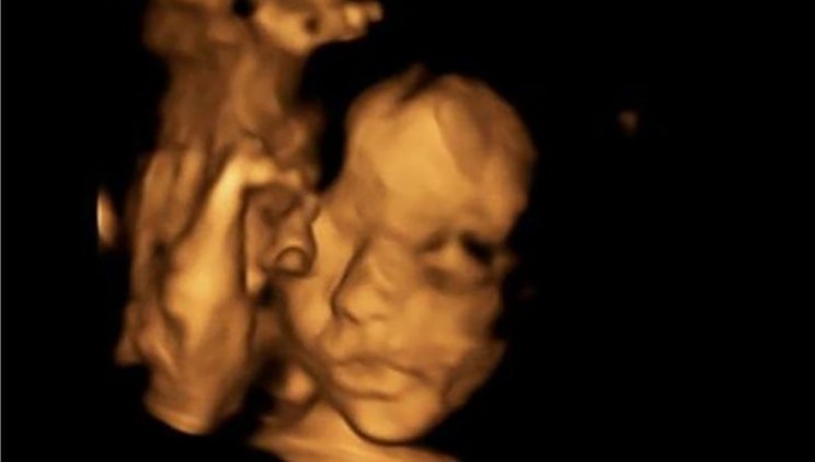 Doctors Operate On Fetus' Spine While It's Still in the Womb