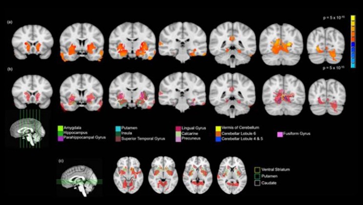 Dazed and Confused: Weed Could Be Changing the Teenage Brain, Says a New Study