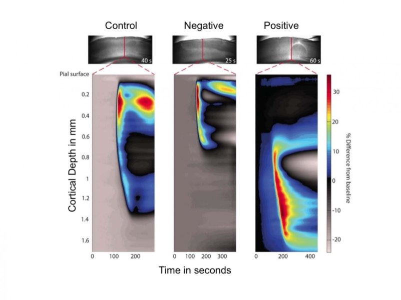 Researchers Identified the Brain's Electrical Activity Responsible for Migraines Researchers Identified the Brain's Electrical Activity Responsible for Migraines
