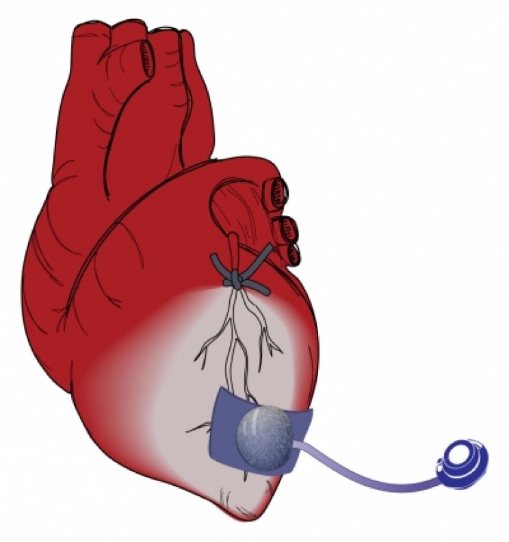 New Tiny Heart Device Could Stop Heart Disease in Its Tracks New Tiny Heart Device Could Stop Heart Disease in Its Tracks