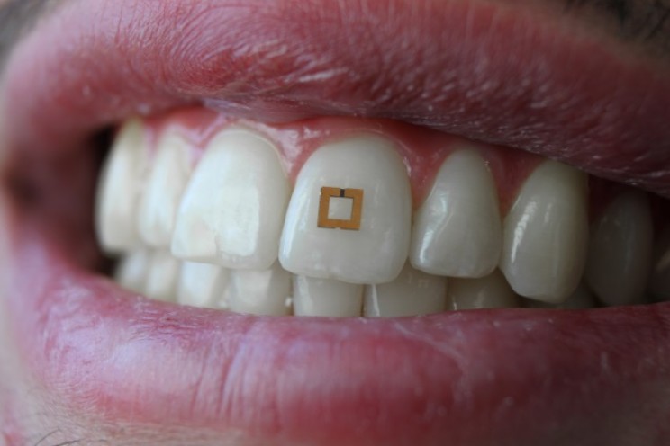 Tooth Sensors Could Be Used to Monitor Your Diet