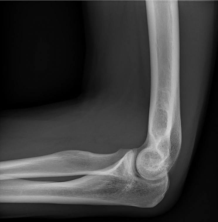 myths about x-rays cancer