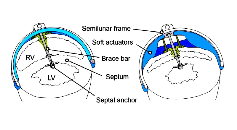 This Soft Robot Saves Failing Hearts By Mimicking Cardiac Muscle This Soft Robot Saves Failing Hearts By Mimicking Cardiac Muscle