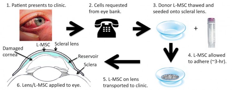 New Therapeutic Contact Lenses Could Heal Eye Injuries New Therapeutic Contact Lenses Could Heal Eye Injuries