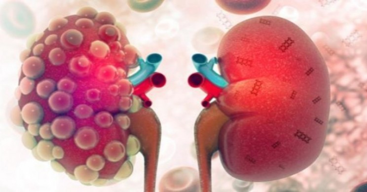 Revolutionary Nanotech Offers Life-Saving Kidney Solution