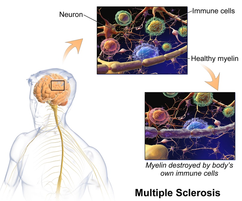An Over-The-Counter Allergy Drug Is Reversing Damage Done by Multiple Sclerosis An Over-The-Counter Allergy Drug Is Reversing Damage Done by Multiple Sclerosis