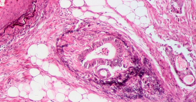 New Hope for Cancer Patients Comes in Form of 150-Year-Old Drug