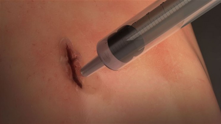 New Fast-Sealing Surgical Glue Closes Wounds in a Minute