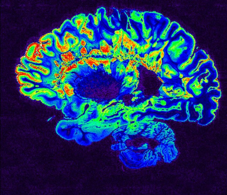 Multiples-Sclerosis Multiple Sclerosis