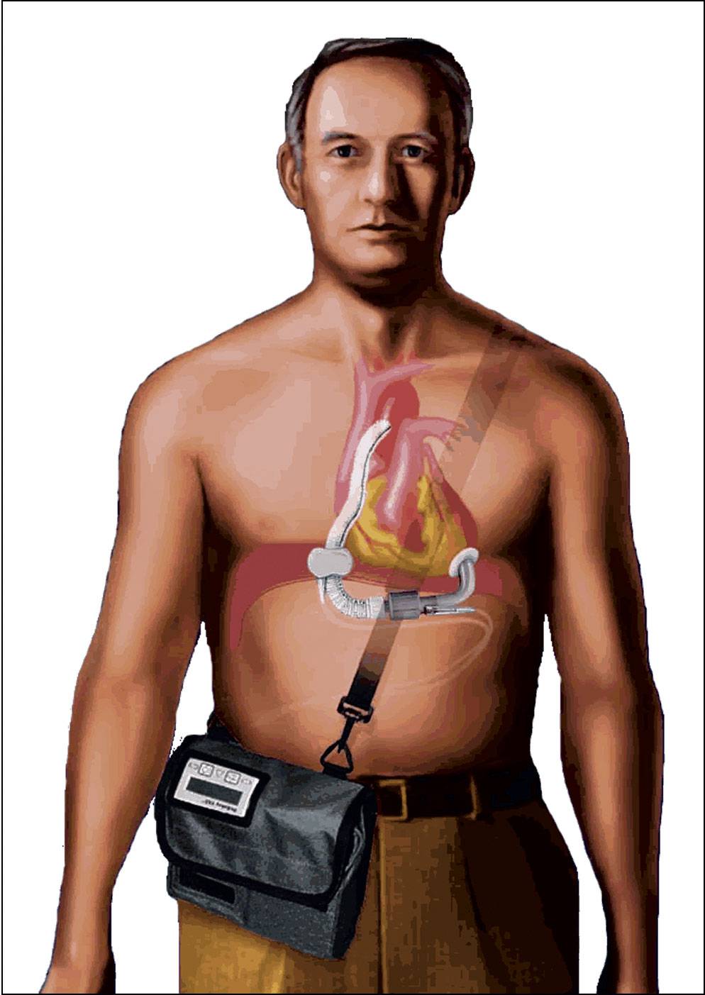NASA spinoffs Artificial Heart