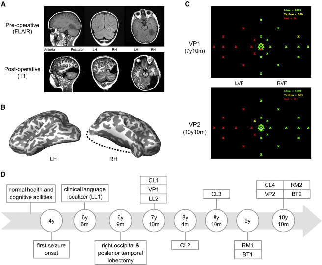 Boy Who Had One-Sixth of His Brain Removed Adapts to Function Exceptionally Well Boy Who Had One-Sixth of His Brain Removed Adapts to Function Exceptionally Well