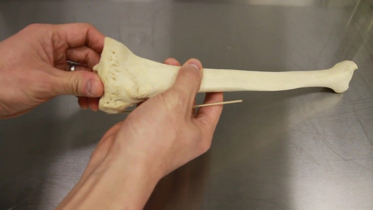 Australian Man Gets World's First 3D Printed Tibia Replacement
