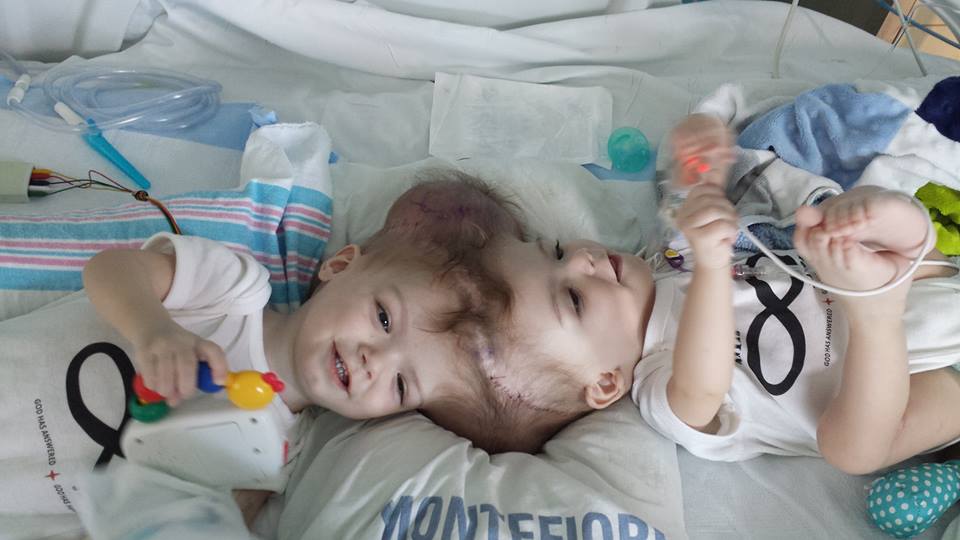 Doctors Successfully Separate Twin Boys Conjoined At The Head