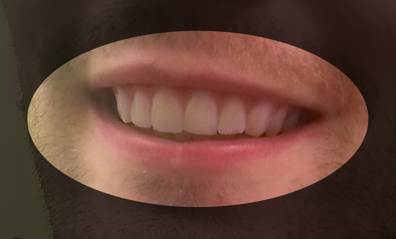 Dudley with his straightened out teeth