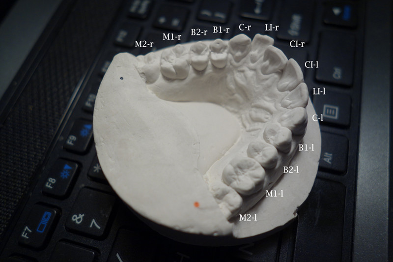 teeth mold showing an overlapping front tooth