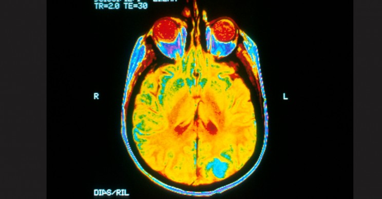 New Study Uses MRI Scans to Predict Alzheimer's and Dementia