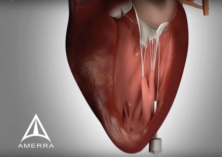 Heart Harpoon Repairs Hearts Without Invasive Surgery
