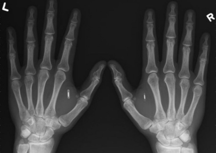 Information Implants: A New Smart Device?