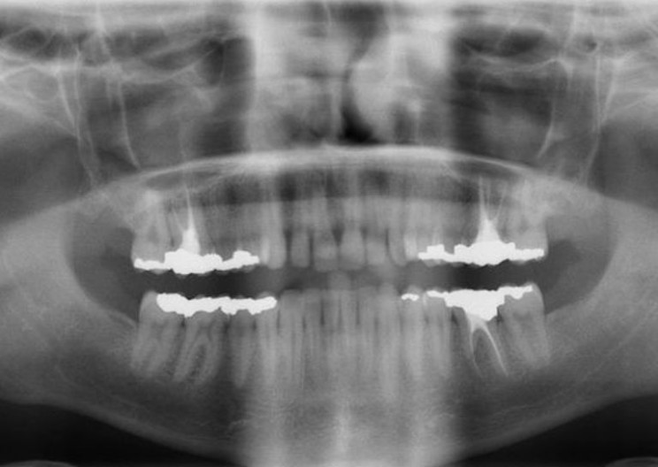 Scientists Develop Regenerative Fillings from Stem Cells