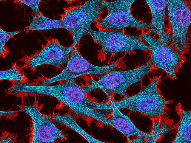 The Immortal Woman: Henrietta Lacks and HeLa Cells The Immortal Woman: Henrietta Lacks and HeLa Cells