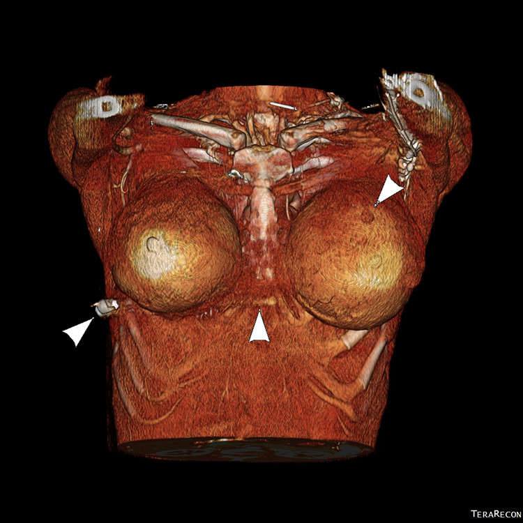 Breast Implants Save Woman's Life by Deflecting Bullet Away From Her Heart Breast Implants Save Woman's Life by Deflecting Bullet Away From Her Heart