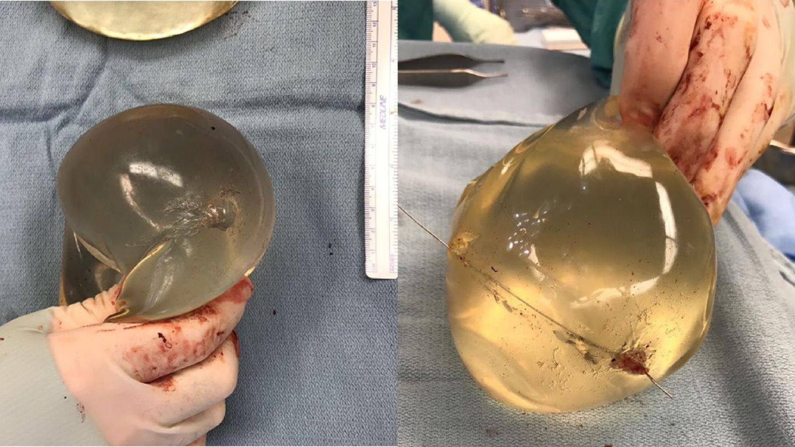 Breast Implants Save Woman's Life by Deflecting Bullet Away From Her Heart Breast Implants Save Woman's Life by Deflecting Bullet Away From Her Heart