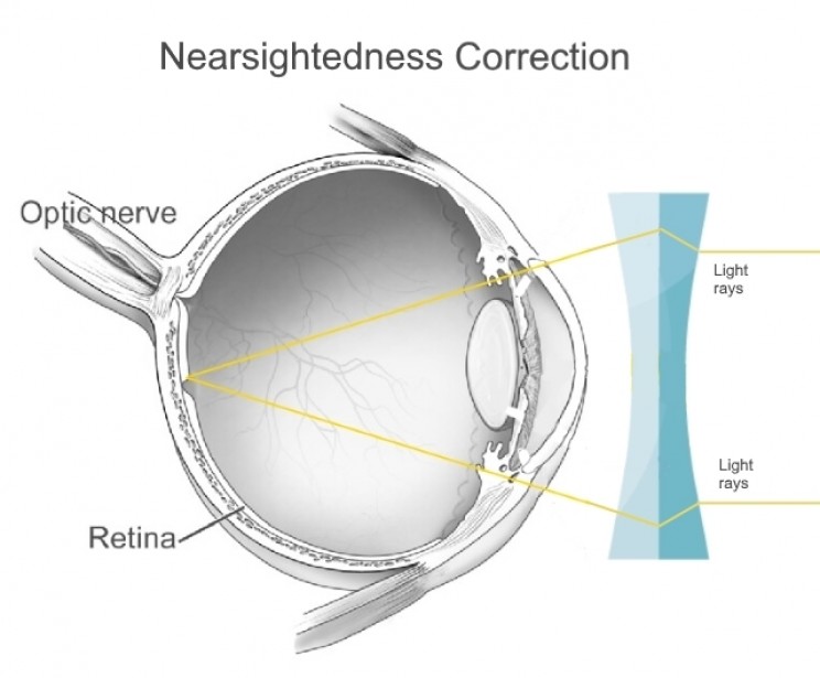 Concave lens Concave lens