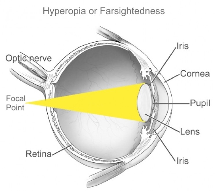 Hyperopia or farsightedness Hyperopia or farsightedness