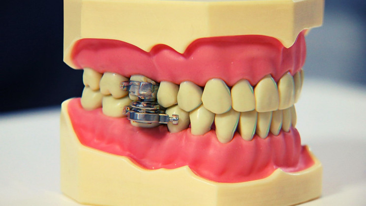 Yes, This 'Weight Loss Device' Really Locks Your Jaw Shut