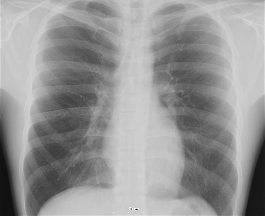 CT-Scans and X-Rays Display the Damage to the Lungs of COVID-19 Patients CT-Scans and X-Rays Display the Damage to the Lungs of COVID-19 Patients