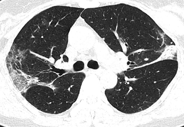 CT-Scans and X-Rays Display the Damage to the Lungs of COVID-19 Patients CT-Scans and X-Rays Display the Damage to the Lungs of COVID-19 Patients