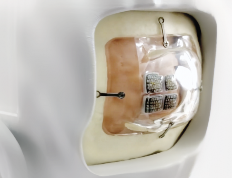 World's First Cortical Vision System Ready for Human Trials World's First Cortical Vision System Ready for Human Trials