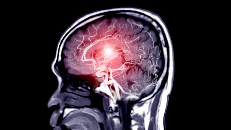 Scientists used magnetic resonance imaging to show brain inflammation in vivo for the first time