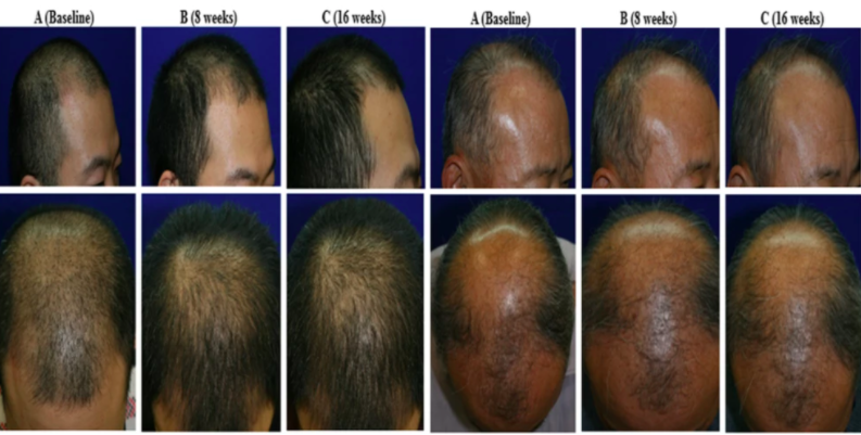 Baldness Cure Possible with Stem Cell Topical Solution Baldness Cure Possible with Stem Cell Topical Solution