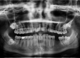 How Do X-Rays Work?
