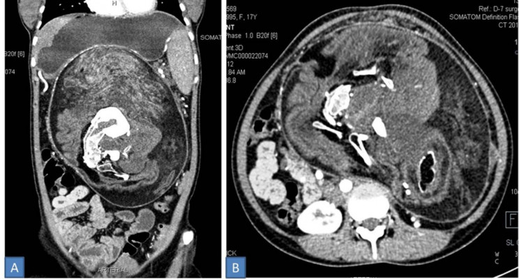 A Teen's Stomach Pain Was Caused by Remnants of Her Parasitic Twin A Teen's Stomach Pain Was Caused by Remnants of Her Parasitic Twin