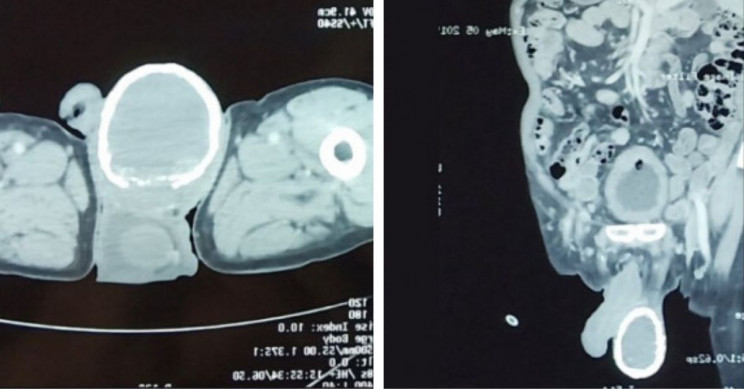 Doctors Discover Man's Enlarged Testicle Is Calcifying and Swimming in Fluid