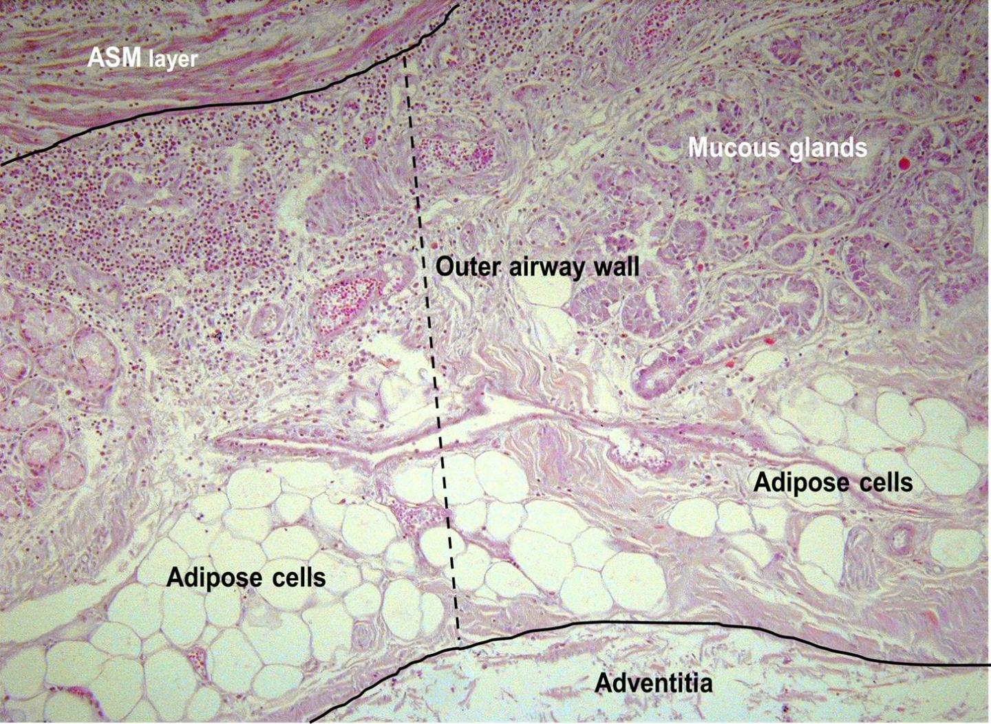 New Study Finds That Fat Accumulates in the Lungs of Obese and Overweight People New Study Finds That Fat Accumulates in the Lungs of Obese and Overweight People