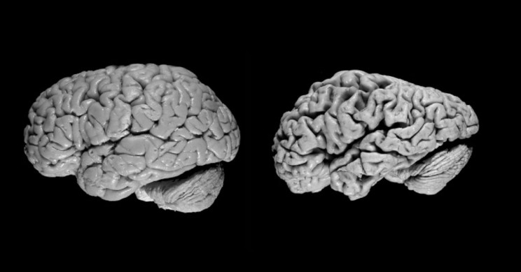 Pre-Clinical Vaccine Targets Nerve Cell Plaques, Slows Down Alzheimer's