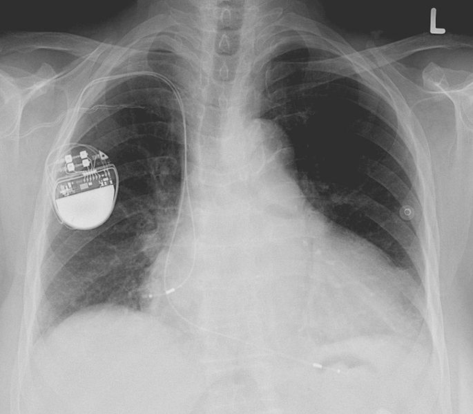lines of code pacemaker
